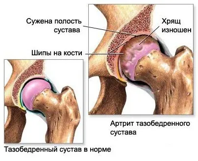 Нарости на суглобах причини, лікування (народні засоби) Нарости на суглобах причини, лікування