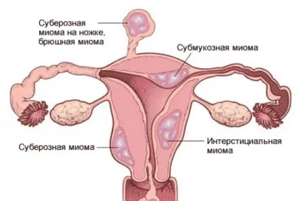 Назва свічок від міоми матки (назва) Назва свічок від міоми матки