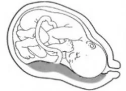 Alacsony placenta previa