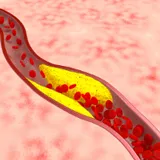 Atherosclerosis az artériák az alsó végtagok - okai, tünetei, kezelése, BNO kód