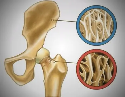 Osteopenia diagnosticelor coloanei vertebrale lombare și tratamentul