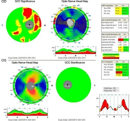 tomografia optica coerenta a retinei si a nervului optic