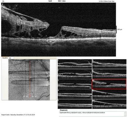 tomografia optica coerenta a retinei si a nervului optic