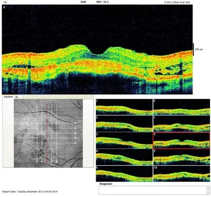 tomografia optica coerenta a retinei si a nervului optic