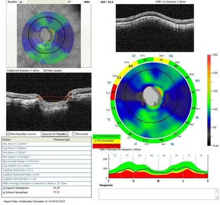 tomografia optica coerenta a retinei si a nervului optic