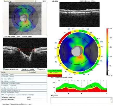 tomografia optica coerenta a retinei si a nervului optic