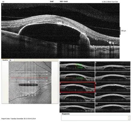 tomografia optica coerenta a retinei si a nervului optic