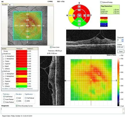 tomografia optica coerenta a retinei si a nervului optic