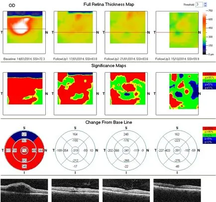 tomografia optica coerenta a retinei si a nervului optic