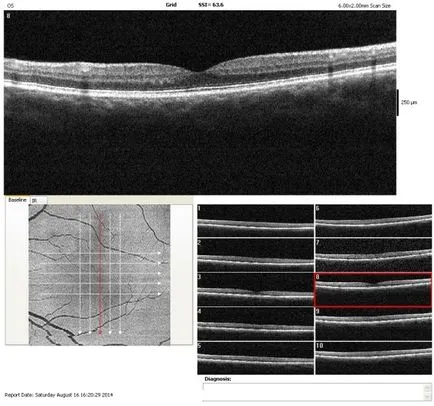 tomografia optica coerenta a retinei si a nervului optic