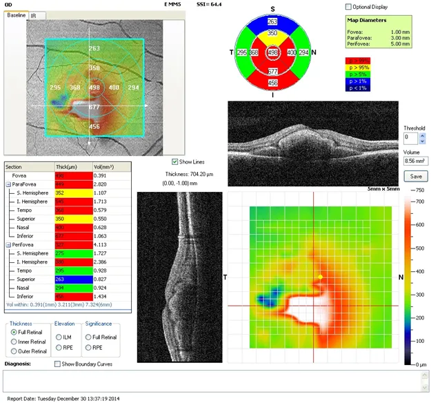 tomografia optica coerenta a retinei si a nervului optic