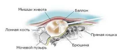 Отворени тайни за началния етап на простатит