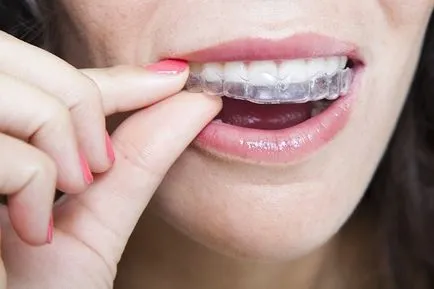 Fehérítőszerek a fogak készítmények, fogászati ​​kezelés