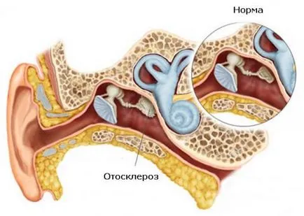 simptome otoscleroză si tratament, remedii populare