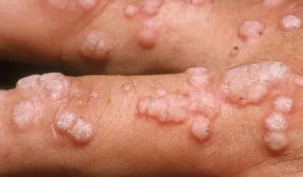 infectia cu HPV la femei, ceea ce este, simptomele decât pentru a trata