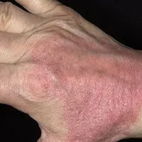 Szóbeli dermatitis gyermek okoz, kezelések