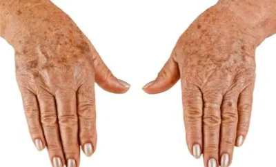 Кафяви петна по ръцете се появяват защо и как да се отървете