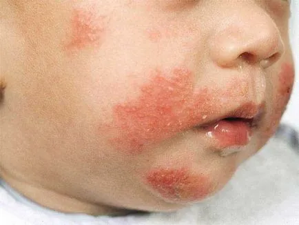 Орална дерматит при деца и възрастни
