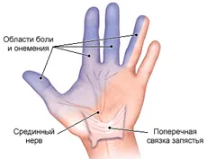 Полиневропатия - диагностика и лечение