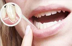 Мобилност степен зъби, причини и лечение