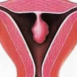 Endometrial simptome polip, tipuri, tratarea și eliminarea de polipi in uter