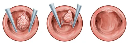 Endometrial simptome polip, tipuri, tratarea și eliminarea de polipi in uter