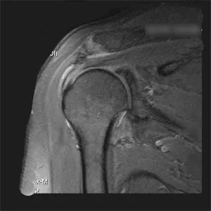 Avantajele IRM a articulației umărului