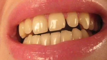 Избелване на зъбите продукти у дома преглед на най-добрите средства за