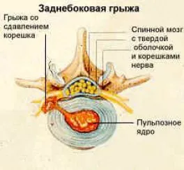 Semne si simptome ale unei hernie de disc - diagnostic, pentru chirurgie indicații