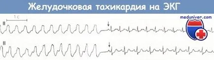 Simptomele de tahicardie ventriculară pe ECG