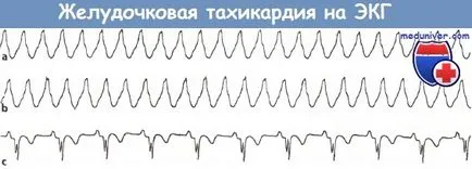 Tünetei kamrai tachycardia az EKG