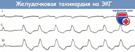 Tünetei kamrai tachycardia az EKG