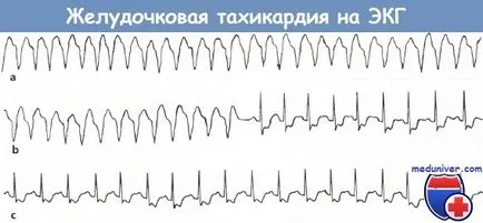 Simptomele de tahicardie ventriculară pe ECG