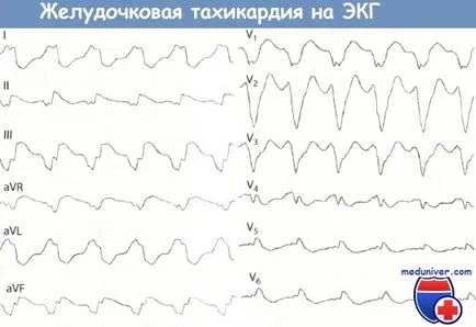 Simptomele de tahicardie ventriculară pe ECG