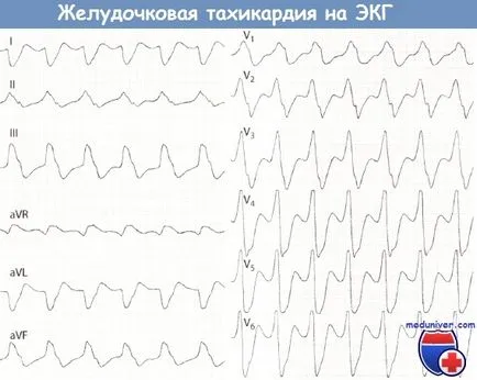 Simptomele de tahicardie ventriculară pe ECG