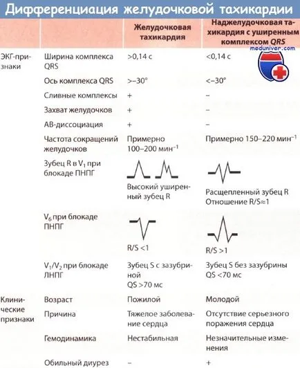 Simptomele de tahicardie ventriculară pe ECG