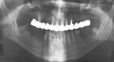 Protetica pe un suport de sticlă ZX 27, Ghid pentru Stomatologie