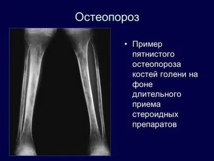 Spotted (focale), osteoporoza este ceea ce este, provoacă, complicații