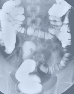 Рентгенови лъчи на червата, както и когато го правят показва вредни или не