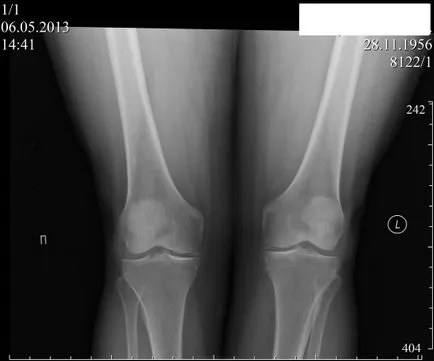 Рентгенови лъчи на колянната става - че показва снимка