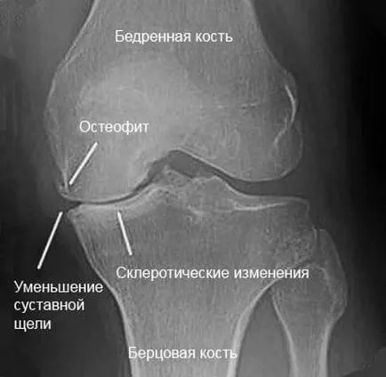 Рентгенови лъчи на колянната става изглежда като в нормални и патологични състояния