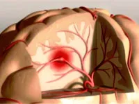 Симптоми и признаци на мозъчен инсулт