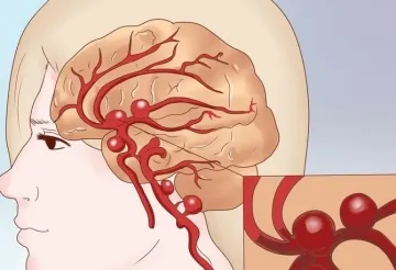 Simptome și metode pentru tratarea unui anevrism cerebral