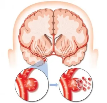 Simptome și metode pentru tratarea unui anevrism cerebral