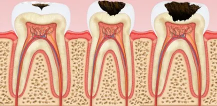 Tünetei és kezelése hypoparathyreosis