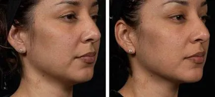 Thermage лицеви козметици и отзивите на клиентите, снимки преди и след