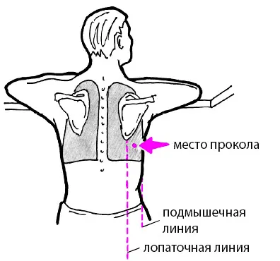 Thoracentesis (thoracentesis) leolvasott, teljesítmény technika