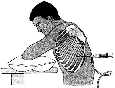 Thoracentesis, a teljesítmény technika, ellenjavallatok