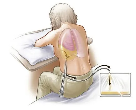 Thoracentesis (торакоцентеза) показания, техника производителност