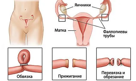 Премахване на въздействието на фалопиевите тръби